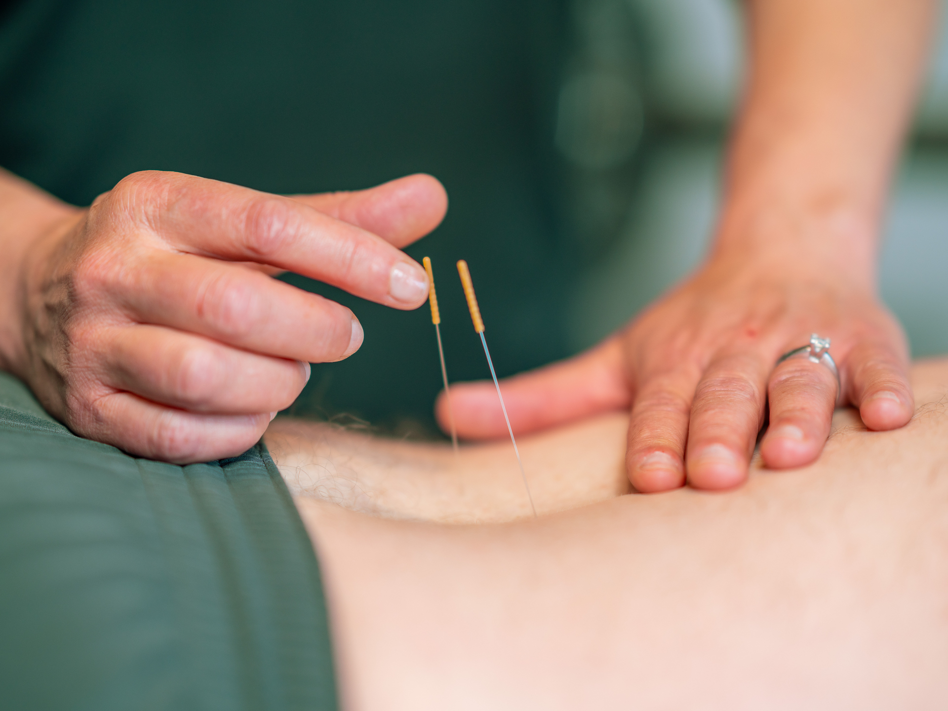 121 Physical Therapy Clarkston & Troy, Michigan Dry Needling Therapy
